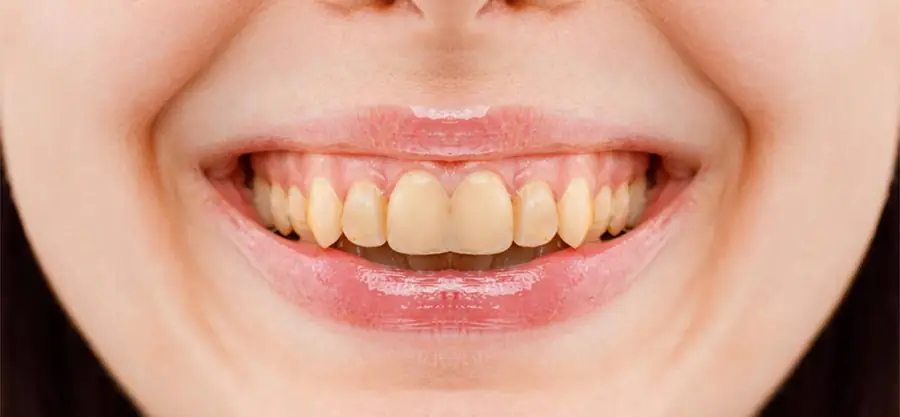 Before treatment, case 3