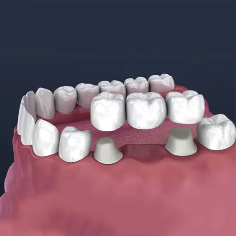 Dental Crowns & Bridges in Lucknow at Apex Dentals