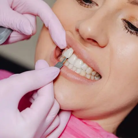 Dental Veneers in Lucknow at Apex Dentals