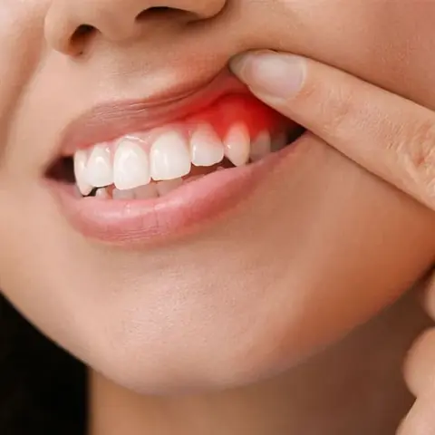 Gum Related Therapy in Lucknow at Apex Dentals