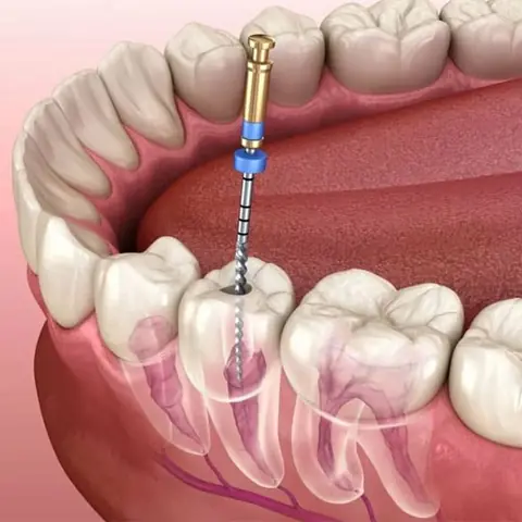 Root Canal Treatment in Lucknow at Apex Dentals