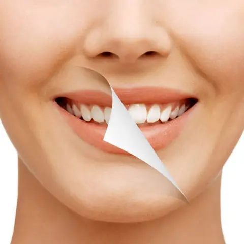 Smile Designing in Lucknow at Apex Dentals