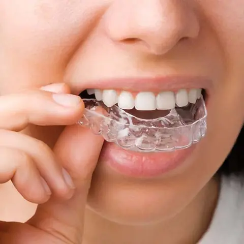 Teeth Alignment (Braces) in Lucknow at Apex Dentals