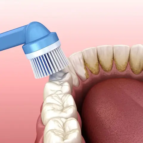 Teeth Cleaning in Lucknow at Apex Dentals