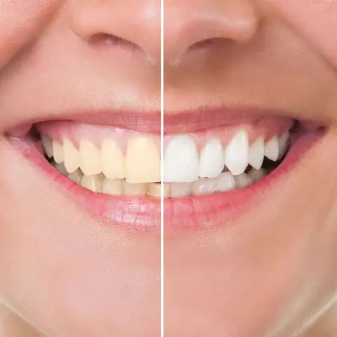 Teeth Whitening in Lucknow at Apex Dentals