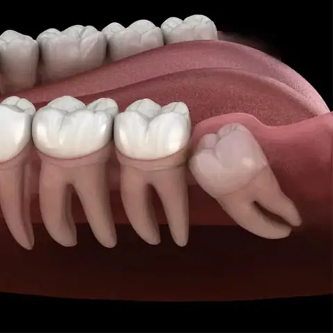 Wisdom Teeth Removal in Lucknow at Apex Dentals