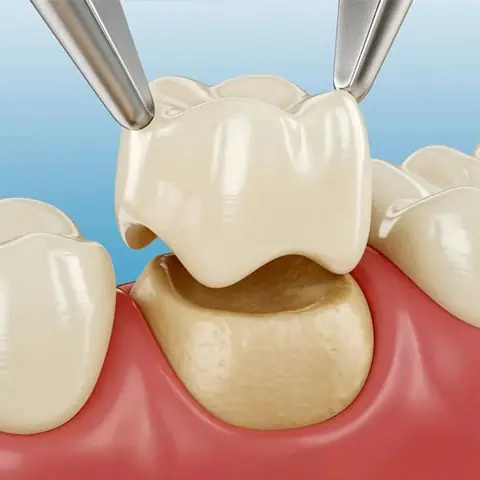 Zirconia Crowns in Lucknow at Apex Dentals